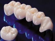 Чем хороши циркониевые коронки