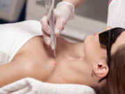 Как избавиться от бородавки