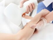 Лазерная эпиляция рук: особенности и преимущества процедуры