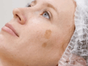 Побочные эффекты после лазерной терапии и как их избежать