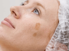 Побочные эффекты после лазерной терапии и как их избежать