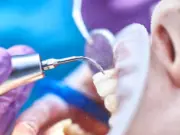 Виды отбеливания зубов