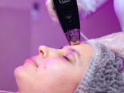 Микроигольчатый RF-лифтинг: возвращаем молодость без скальпеля