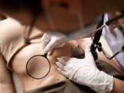 Все о невусах: типы, диагностика, лечение и профилактика