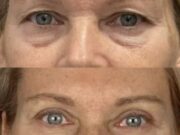 Круговая блефаропластика, маммопластика и выбор хирурга