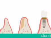 Костная пластика: когда она нужна и как проходит восстановление